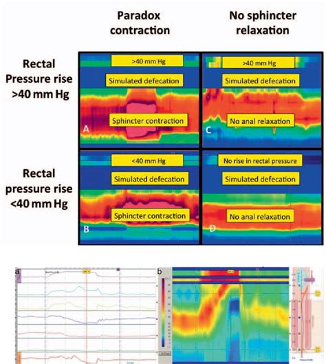 Figure 1 from High-Resolution Anorectal Manometry - New Insights in the ...