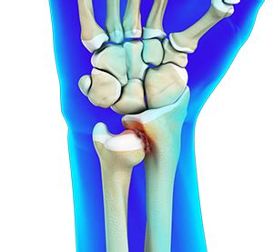 Distal Radioulnar Joint