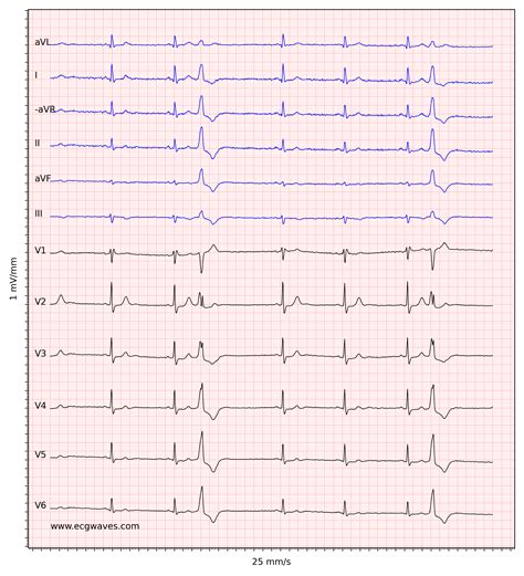 Sinus Bradycardia: Definitions, ECG, Causes And Management, 58% OFF