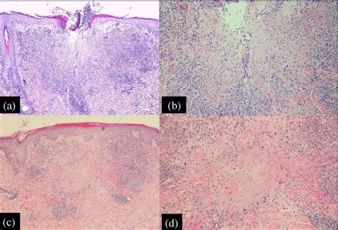 Histology of the matured lesion from the neck and of the early lesion ...