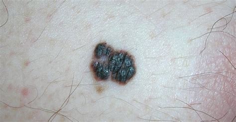 Skin Cancer - Types, Symptoms - Melanoma & Treatment