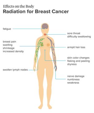 What are the side effects of radiation for breast cancer? - OHC