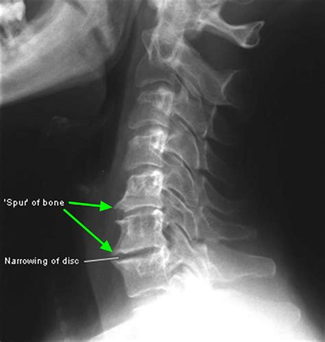 Bone Spur - Osteophytes, Causes, Signs, Symptoms & Treatment