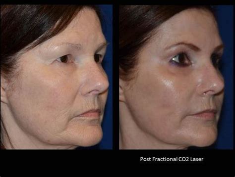 Fractional CO2 Laser Before & After - Charlotte Huntersville, NC: Saluja Cosmetic and Laser Center