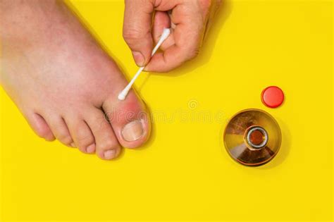 Gout on the Big Toe Treatment with Therapeutic Ointment Stock Image ...