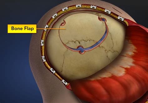 Craniotomy – Craniectomy Essential Brain Surgery - Chicago Brain Damage