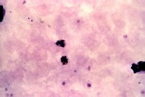 Free picture: photomicrograph, shows, red, blood, cell, infection, plasmodium vivax, schizont ...
