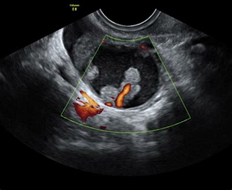 Normal Ovary Ultrasound