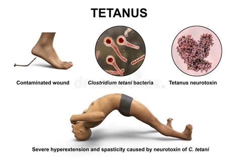 Tetanus Disease, Opisthotonus in a Man Suffering from Tetanus Stock Illustration - Illustration ...