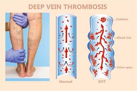 Blood Test Indicator For Blood Clot at Ramiro Smith blog