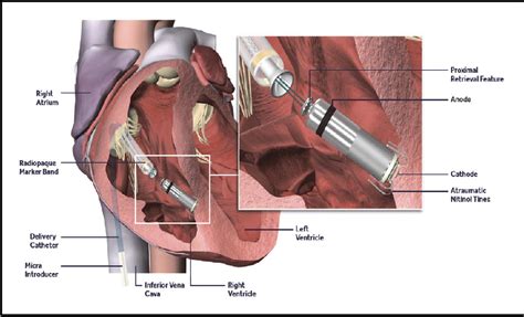 Figure 1 from Performance of Leadless Pacemaker in Japanese Patients vs. Rest of the World ...