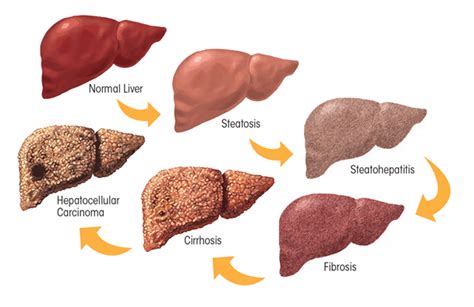 Alcoholic Liver Disease: Pathogenesis and Current Management | Alcohol ...