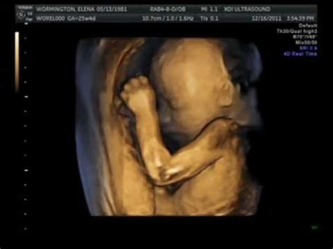 3D ultrasound 25 weeks, 4D view of baby, 25 week pregnancy, baby girl, first view - YouTube