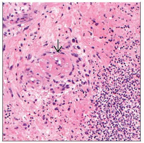 Ecthyma Gangrenosum | Basicmedical Key