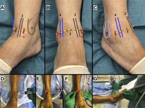 Fibular Intra-articular Resection During Arthroscopic Ankle Arthrodesis: The Surgical Technique ...