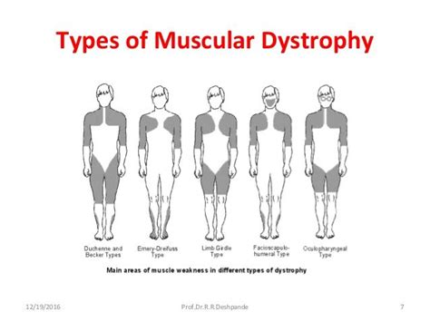 90 best **Bethlem Myopathy - Congenital Muscular Dystrophy images on Pinterest | Chronic fatigue ...