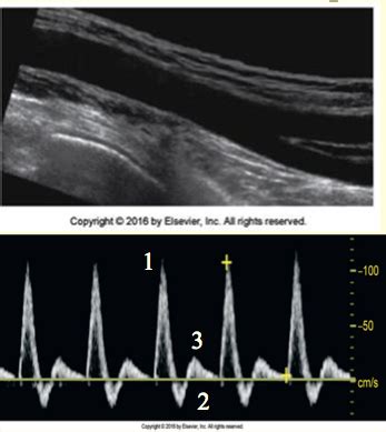 Lower Extremity Arterial Duplex Scanning Techniques Flashcards | Quizlet