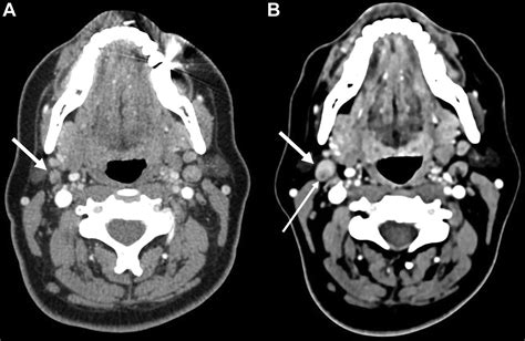 Lymph Node Dissection | Radiology Key