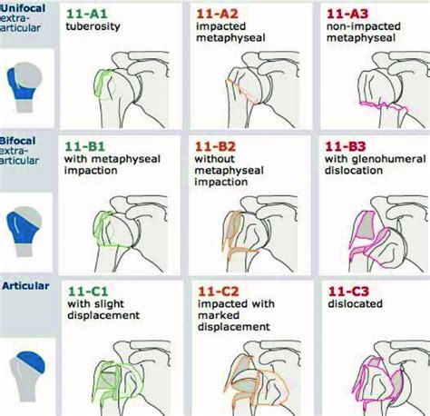 Proximal humerus fracture ao 463327-Proximal humerus fracture ao ...