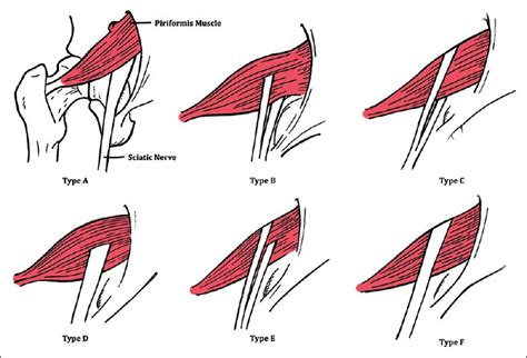 Diagnosis and Management of Piriformis Syndrome: A Rare Anatomic ...