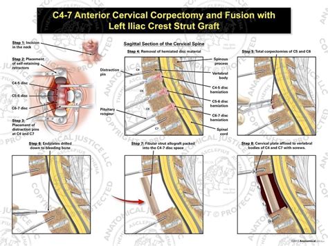 C4-7 Anterior Cervical Corpectomy and Fusion with Fibular Strut Graft