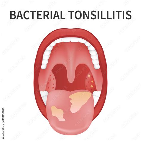 Bacterial and viral tonsillitis. Angina, pharyngitis, and tonsillitis ...