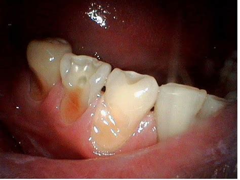 Tooth Abrasion