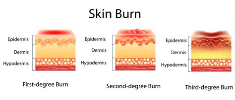 Coverage for Accidental Burns under Health Insurance