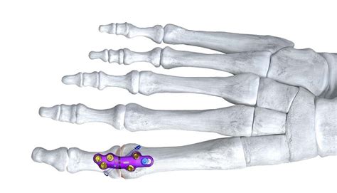 1st MTP Joint (Big Toe Joint) Fusion | Dr Mike Smith | Adelaide