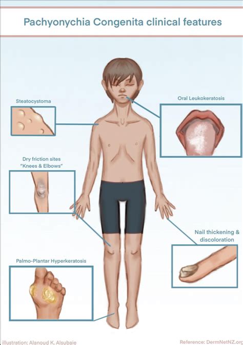 Pachyonychia congenita - الجمعية السعودية لأمراض وجراحة الجلد