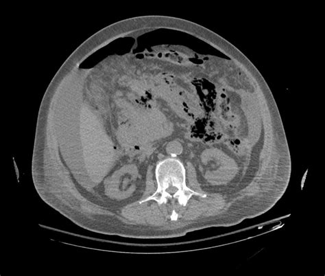 Acute pancreatitis CT - wikidoc