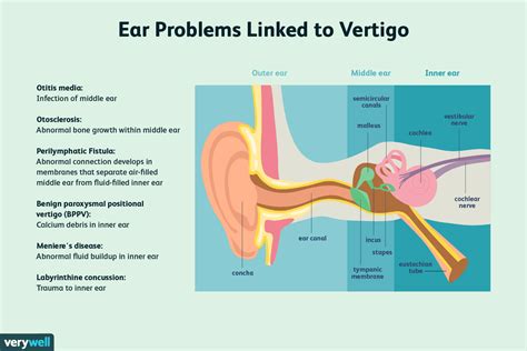 Vertigo: Symptoms, Causes, and More