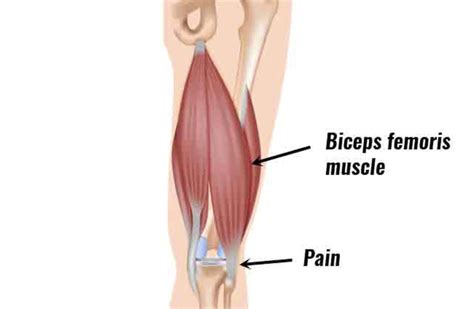 Biceps Femoris Tendinopathy (distal) - Physio and Fitness Clinic