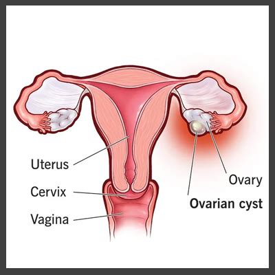 homeopathic treatment for Corpus luteum cyst in homeopathy, Corpus ...