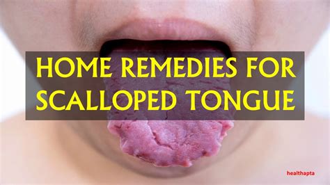 HOME REMEDIES FOR SCALLOPED TONGUE - YouTube