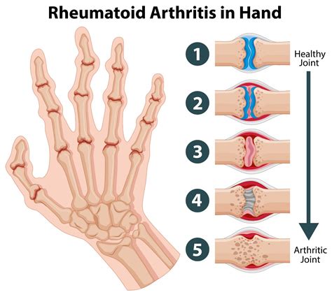 Indian Diet Plan for Rheumatoid Arthritis ( Food List ) - Dietburrp