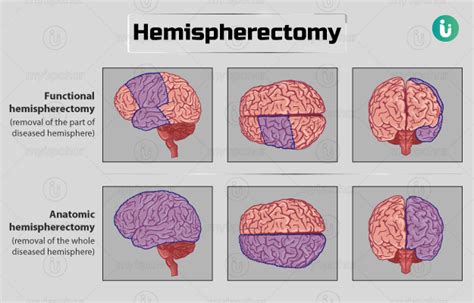 Hemispherectomy: Procedure, Purpose, Results, Cost, Price