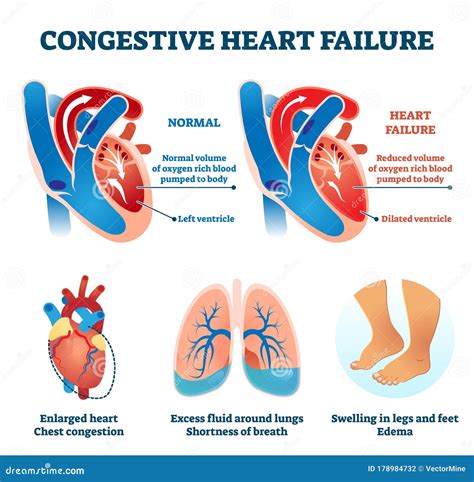 Congestive Heart Failure Vector Illustration. Labeled Medical Compare ...