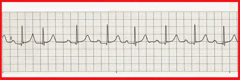 Float Nurse: Practice EKG Rhythm Strips 232