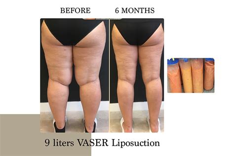 Lipedema | Before & After