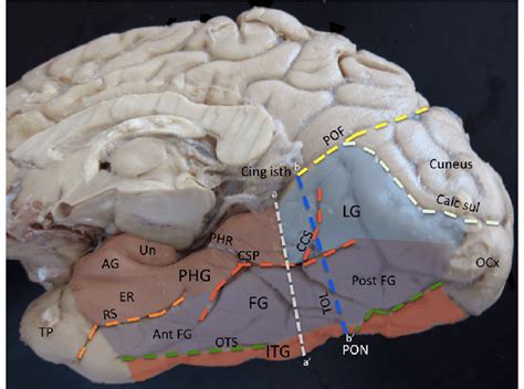 Inferomedial view of the basal occipital–temporal lobe. A coronal line ...