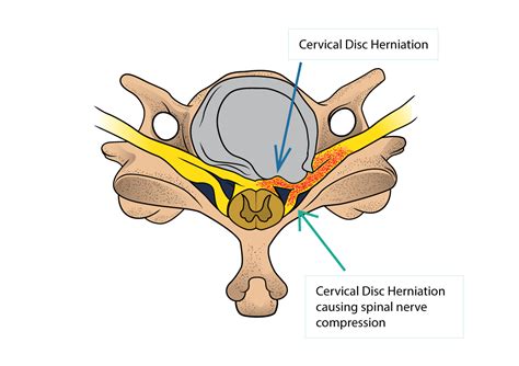 Cervical Disc Herniation and Cervical Radiculopathy | Dr Yu Chao Lee