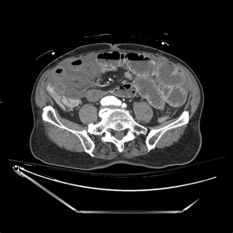 File:Closed loop obstruction due to adhesive band, resulting in small ...