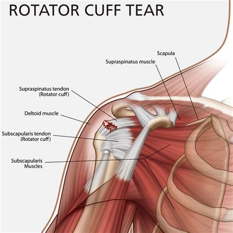 Rotator Cuff Injury: Physical Therapy and Surgery