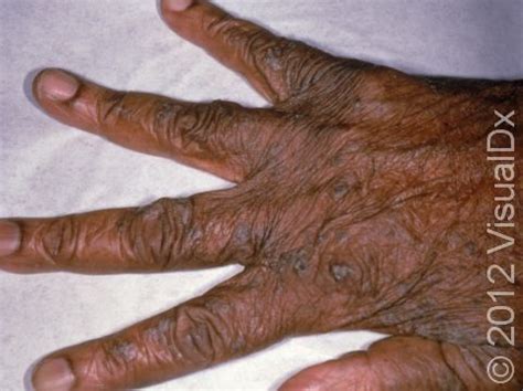 Scabies Rash On Hands