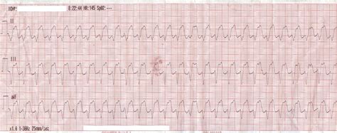 My Variables Only Have 6 Letters: Synchronized Cardioversion: What Happened?