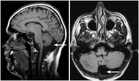 Magnetic resonance imaging midsagital and transverse scans ...