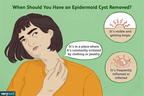 How to Spot and Treat Epidermoid Cysts