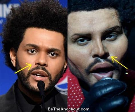 The Weeknd Plastic Surgery Comparison Photos