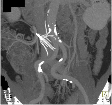 Malpositioned IVC Filter - Vascular Case Studies - CTisus CT Scanning